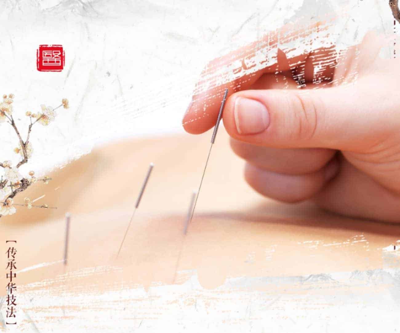 Top Health Benefits of Acupuncture Therapy